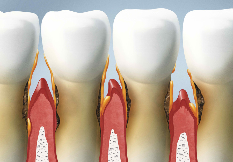 preventive-ways-to-address-root-decay-emergency-dentist-san-jose-ca